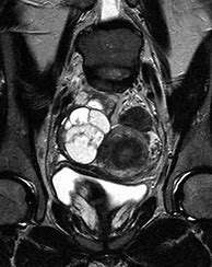 Image result for C Adnexal Cyst On CT Angio