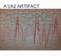 Image result for Normal Variants EEG