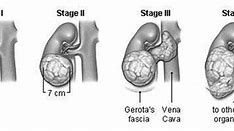 Image result for How Big Is 4 Cm Tumor