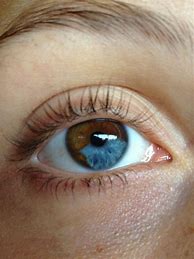 Image result for Heterozygous Eyes