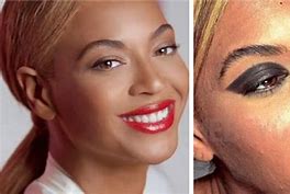 Image result for Beyoncé Acne
