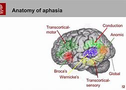 Image result for Aphasia Brain