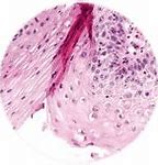 Image result for Genital Wart Identification