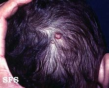 Image result for Molluscum Groin
