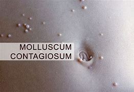 Image result for Molluscum Contagiosum