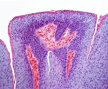 Image result for Female Genital Warts