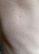 Image result for Molluscum Contagiosum in Adults Scarring