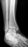 Image result for Broken Ankle Symptoms