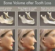 Image result for Before and After Jaw Bone Loss