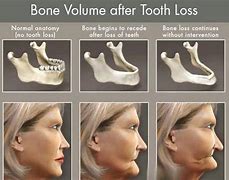 Image result for Loose Teeth Bone Loss