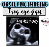 Image result for Frog Eye Sign