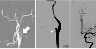 Image result for Left ICA Occlusion