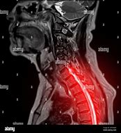 Image result for Cervical Spine MRI with Contrast