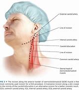 Image result for Carotid Artery Surgery