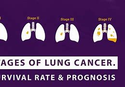 Image result for 4 Stages of Lung Cancer