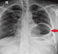 Image result for Traumatic Diaphragmatic Hernia