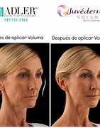 Image result for Juvederm Lips Before and After