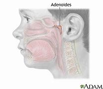 Image result for adenitos