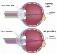 Image result for Eye Sight Diagram Astigmatism