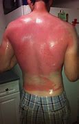 Image result for Funny Sun Burn Pictures