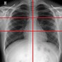 Image result for Covid Pneumonia Chest X-Ray