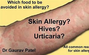 Image result for Skin Allergic Reaction