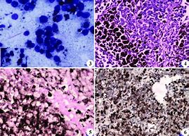 Image result for Melanoma Cells Photo in Body