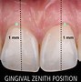 Image result for Gingival Zenith
