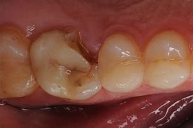 Image result for 8002A Tooth