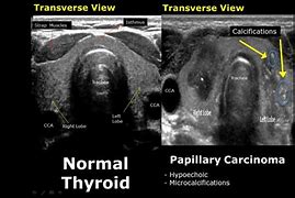 Image result for Thyroid Gland Ultrasound