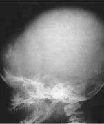 Image result for Anencephaly Syndrome