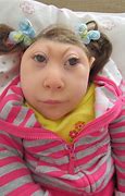 Image result for Anencephalic Baby Girl