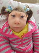 Image result for Long Anencephaly Baby