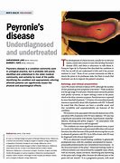Image result for Lapeyronie Disease