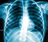 Image result for X-ray of Heart