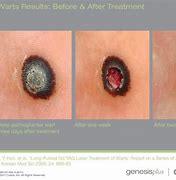 Image result for Compound W Wart Remover Before and After