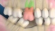 Image result for Dental Acheta