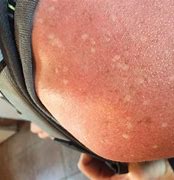 Image result for White Sun Spots On Skin