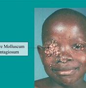 Image result for Molluscum Contagio