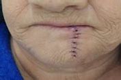 Image result for Squamous Cell On the Lip