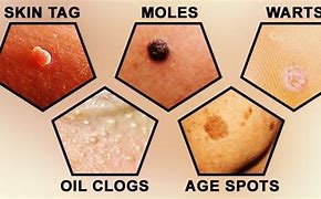 Image result for What Causes Warts On Face
