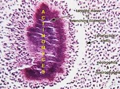 Image result for actinomucosis
