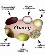 Image result for Cyst On Ovaries with Teeth and Hair