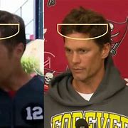 Image result for Tom Brady Hair Loss