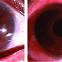 Image result for Open Vs. Closed Angles Slit Lamp