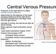 Image result for Central Venous Pressure CVP