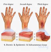 Image result for 3rd Degree Burns On Face