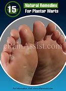 Image result for Plantar Wart Home Remedy