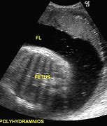 Image result for Polyhydramnios Ultrasound