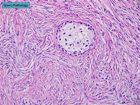 Image result for Brenner Tumor Ovary